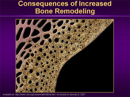 boneremodeling