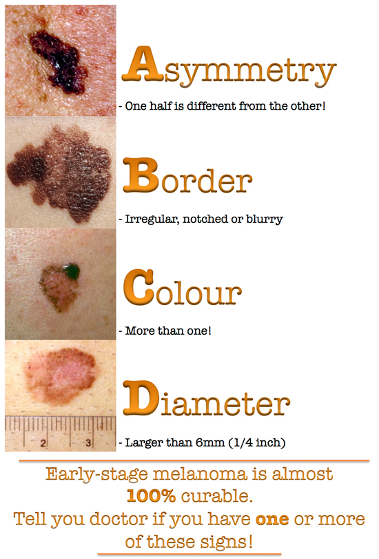 abcd_melanoma